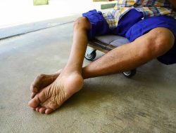 Kepala Dinkes Paparkan Apa Itu Penyakit Polio Sebabkan Kelumpuhan Permanen