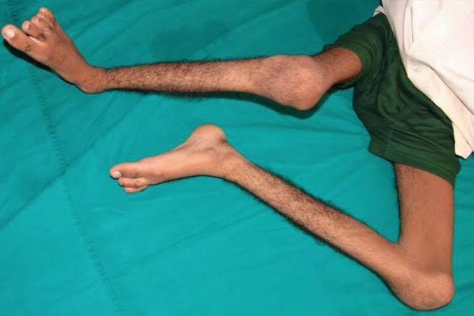 Kenali dan pelajari penyakit polio, Kepala Dinas Kesehatan Kabupaten Kutai Timur (Kutim), dr Bahrani Hasanal mengajak masyarakat kenali gejalanya.