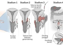 Banyak yang Belum Faham, Kenali Apa Itu Kanker Serviks Biasanya Menyerang Wanita