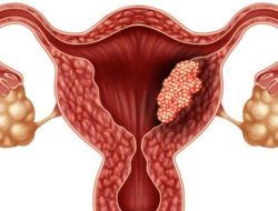 Hati-hati Sering Terjadi Saat Sudah Fatal, Bahrani Ajak Masyarakat Kenali Gejala Kanker Serviks