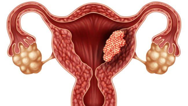Kanker serviks terjadi  ketika sel-sel yang sehat mengalami perubahan atau mutasi.