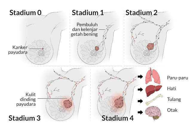Kanker payudara ini terjadi ketika sel-sel pada jaringan yang ada di payudara tumbuh tidak terkendali dan mengambil alih jaringan payudara yang sehat dan sekitarnya.