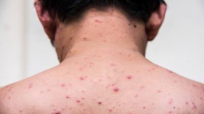 Kenali Gejala Cacar Monyet Menyerang Manusia