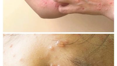 Banyak orang tidak bisa membedakan antara cacar monyet dan cacar biasa.