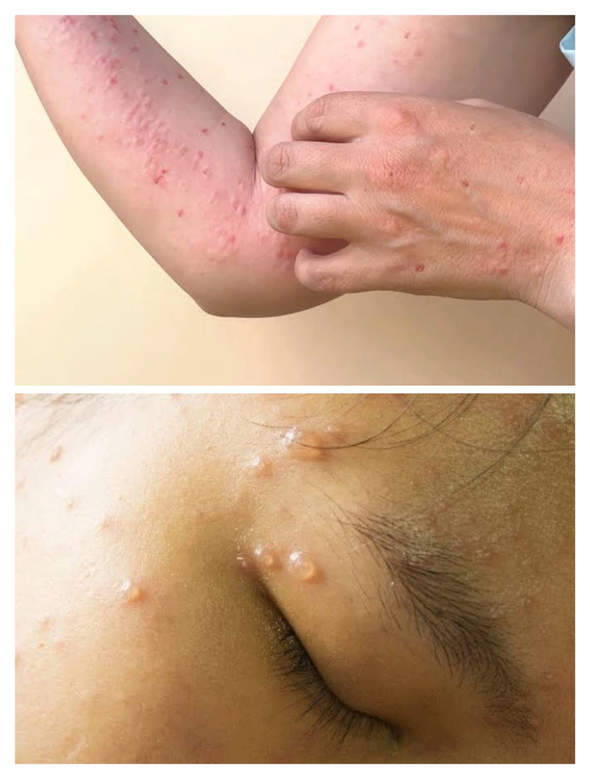 Banyak orang tidak bisa membedakan antara cacar monyet dan cacar biasa.